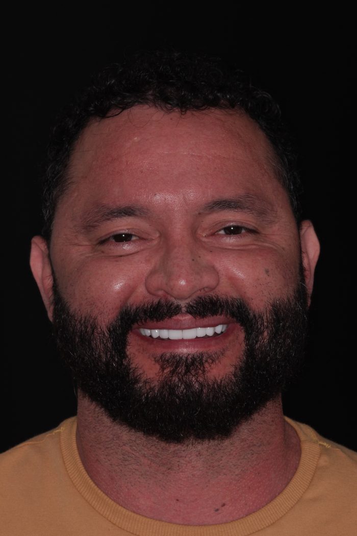 Paciente da Oral Unic Caçador sorrindo após o tratamento